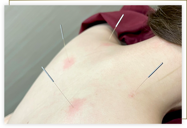 金針施術イメージ